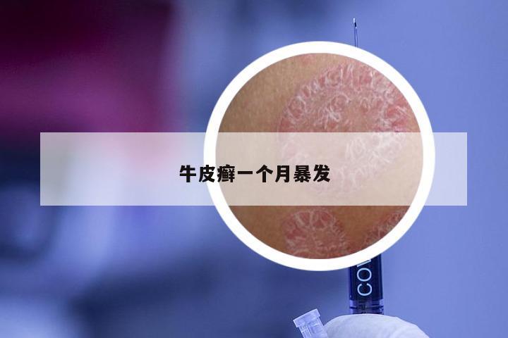 牛皮癣一个月暴发