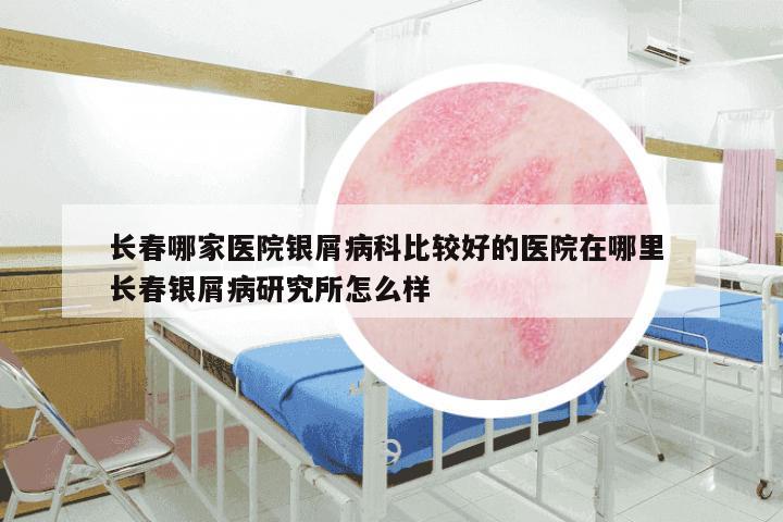 长春哪家医院银屑病科比较好的医院在哪里 长春银屑病研究所怎么样