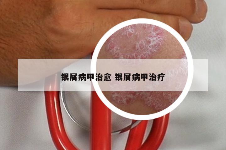银屑病甲治愈 银屑病甲治疗