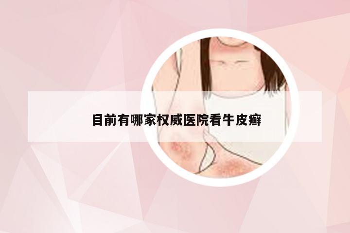 目前有哪家权威医院看牛皮癣