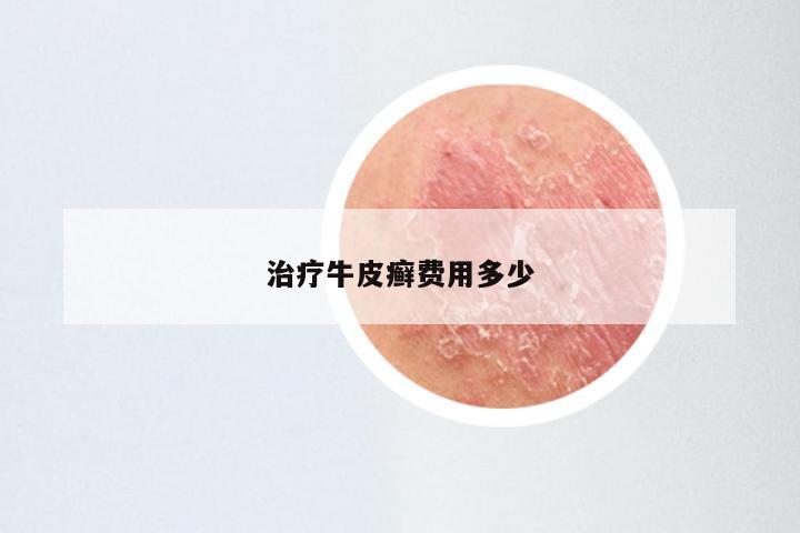 治疗牛皮癣费用多少