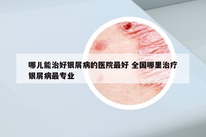 哪儿能治好银屑病的医院最好 全国哪里治疗银屑病最专业