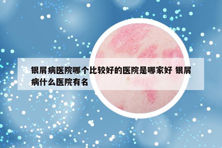 银屑病医院哪个比较好的医院是哪家好 银屑病什么医院有名
