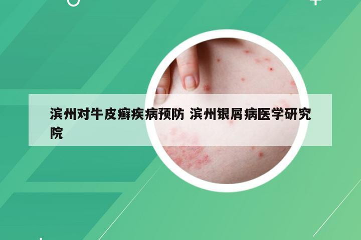 滨州对牛皮癣疾病预防 滨州银屑病医学研究院
