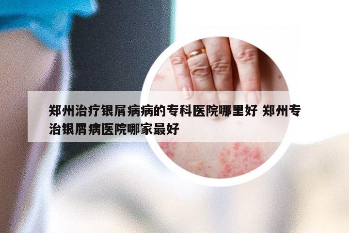 郑州治疗银屑病病的专科医院哪里好 郑州专治银屑病医院哪家最好
