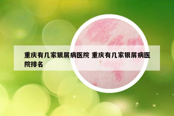 重庆有几家银屑病医院 重庆有几家银屑病医院排名