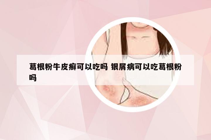 葛根粉牛皮癣可以吃吗 银屑病可以吃葛根粉吗