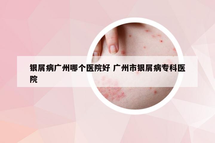 银屑病广州哪个医院好 广州市银屑病专科医院