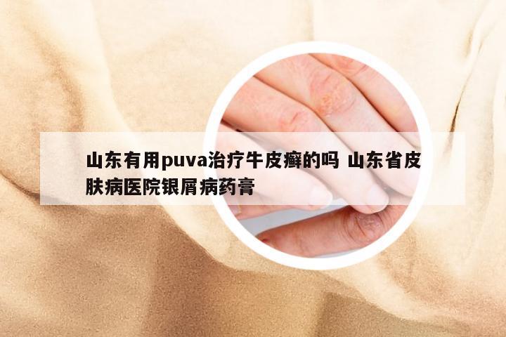 山东有用puva治疗牛皮癣的吗 山东省皮肤病医院银屑病药膏