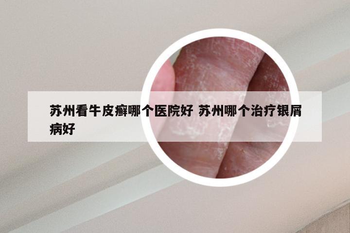 苏州看牛皮癣哪个医院好 苏州哪个治疗银屑病好