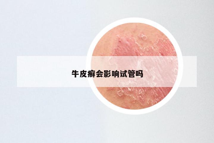 牛皮癣会影响试管吗