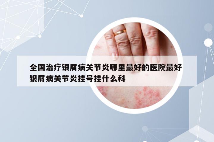 全国治疗银屑病关节炎哪里最好的医院最好 银屑病关节炎挂号挂什么科