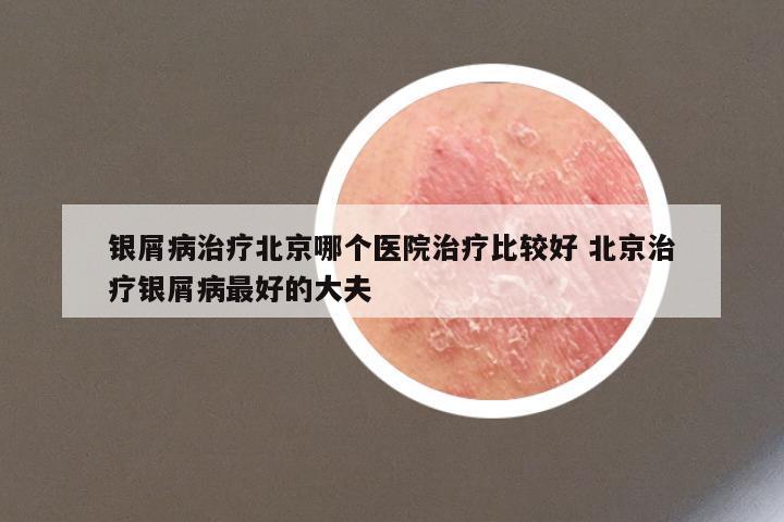 银屑病治疗北京哪个医院治疗比较好 北京治疗银屑病最好的大夫