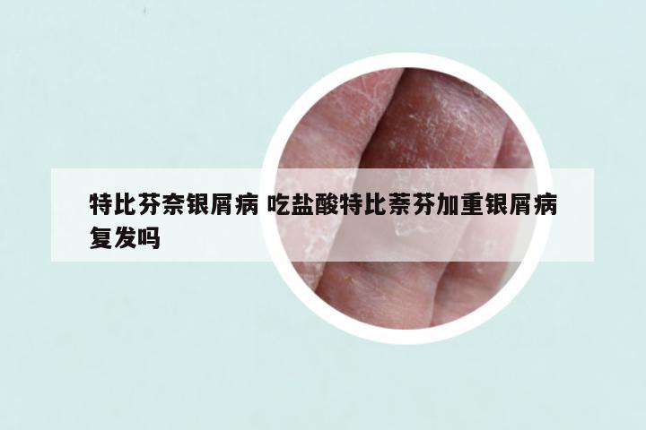 特比芬奈银屑病 吃盐酸特比萘芬加重银屑病复发吗