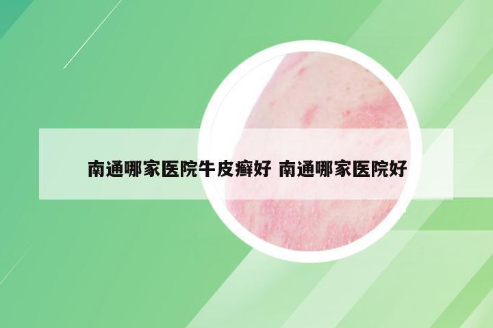 南通哪家医院牛皮癣好 南通哪家医院好
