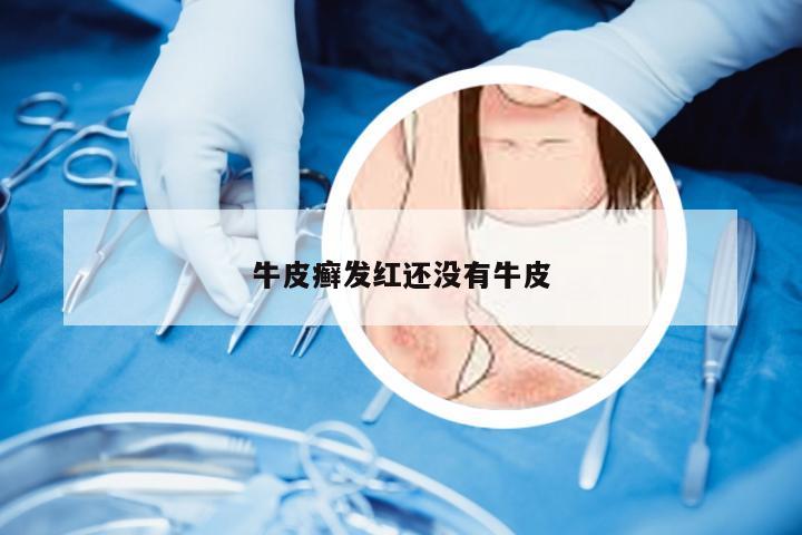 牛皮癣发红还没有牛皮