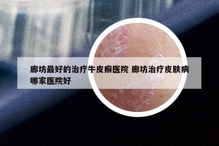 廊坊最好的治疗牛皮癣医院 廊坊治疗皮肤病哪家医院好