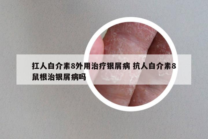 扛人白介素8外用治疗银屑病 抗人白介素8鼠根治银屑病吗