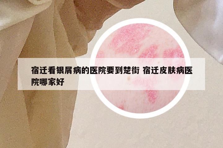 宿迁看银屑病的医院要到楚街 宿迁皮肤病医院哪家好