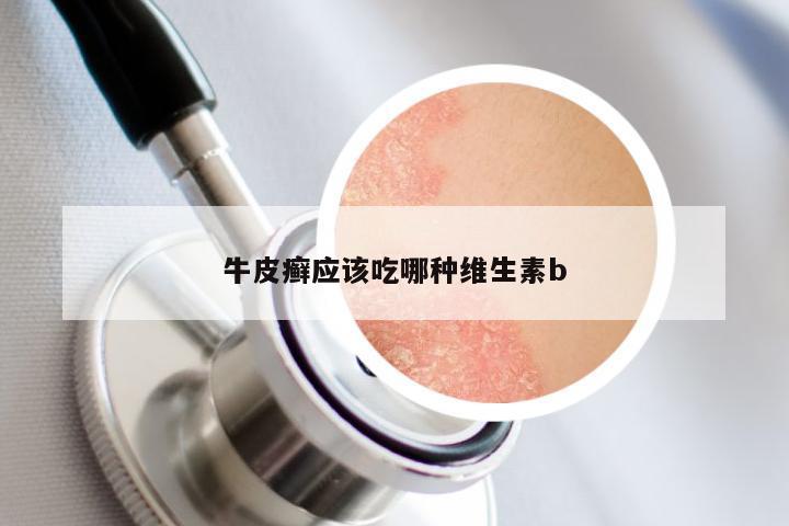 牛皮癣应该吃哪种维生素b