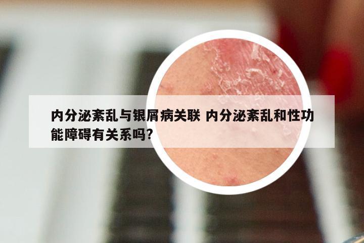 内分泌紊乱与银屑病关联 内分泌紊乱和性功能障碍有关系吗?