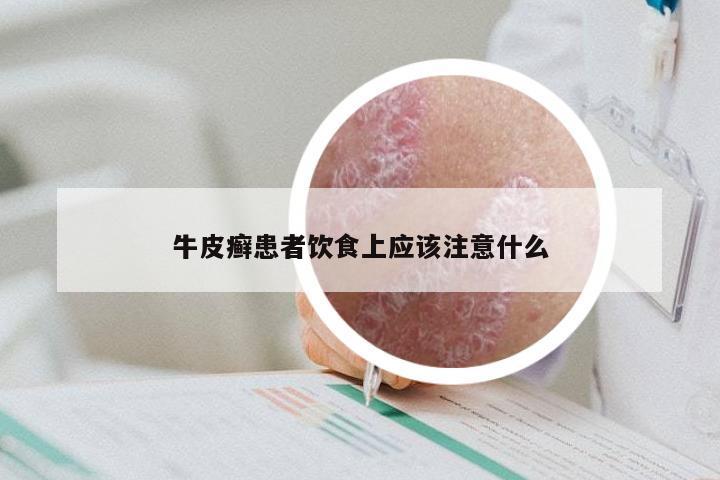 牛皮癣患者饮食上应该注意什么
