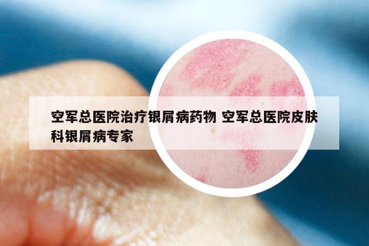 空军总医院治疗银屑病药物 空军总医院皮肤科银屑病专家