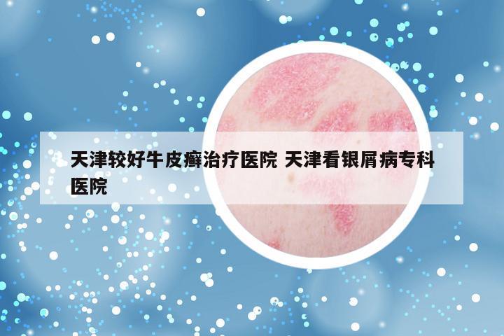 天津较好牛皮癣治疗医院 天津看银屑病专科医院