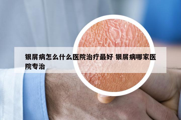 银屑病怎么什么医院治疗最好 银屑病哪家医院专治