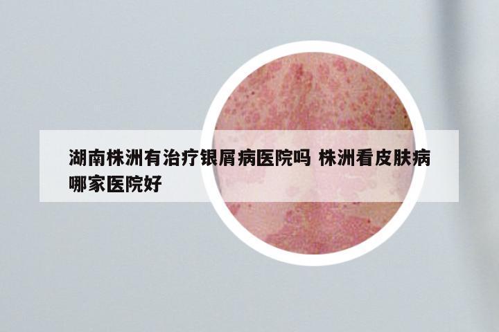 湖南株洲有治疗银屑病医院吗 株洲看皮肤病哪家医院好