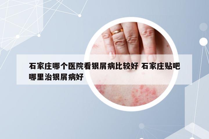 石家庄哪个医院看银屑病比较好 石家庄贴吧哪里治银屑病好