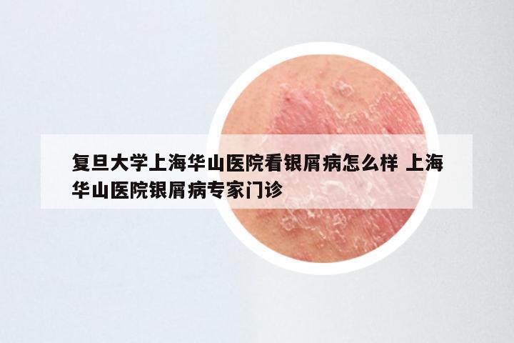复旦大学上海华山医院看银屑病怎么样 上海华山医院银屑病专家门诊