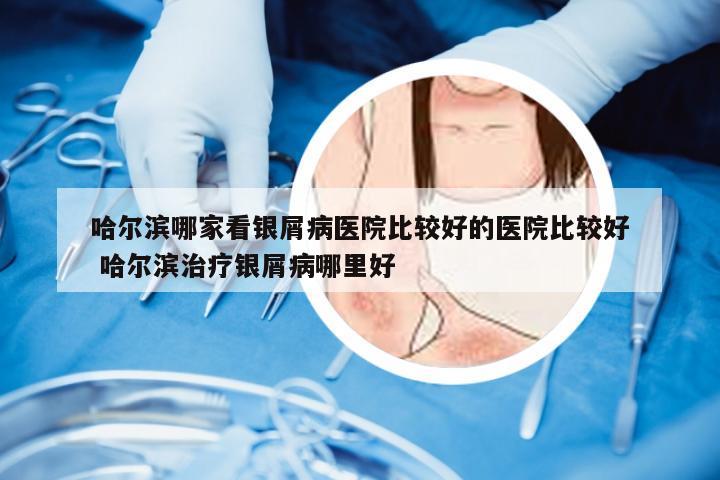 哈尔滨哪家看银屑病医院比较好的医院比较好 哈尔滨治疗银屑病哪里好