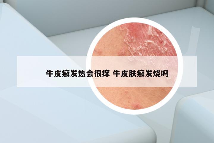 牛皮癣发热会很痒 牛皮肤癣发烧吗