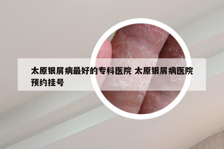 太原银屑病最好的专科医院 太原银屑病医院预约挂号