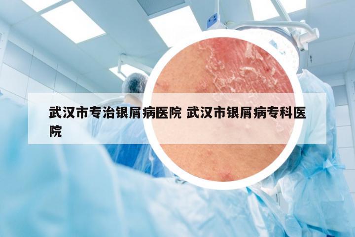 武汉市专治银屑病医院 武汉市银屑病专科医院