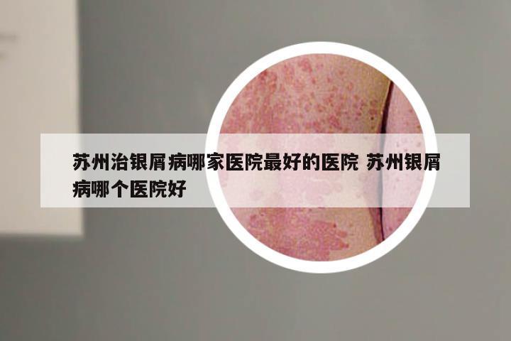 苏州治银屑病哪家医院最好的医院 苏州银屑病哪个医院好