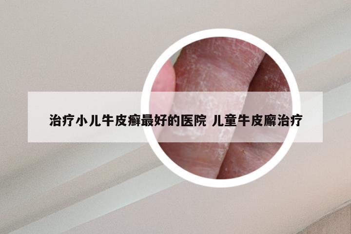 治疗小儿牛皮癣最好的医院 儿童牛皮廨治疗