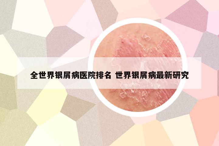 全世界银屑病医院排名 世界银屑病最新研究