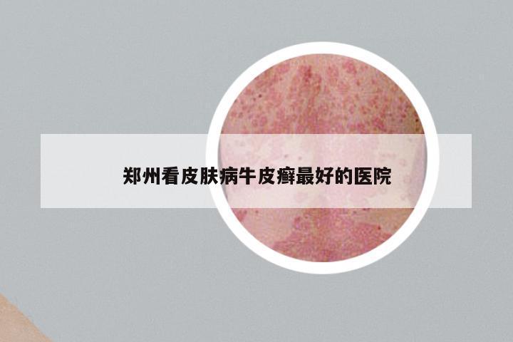 郑州看皮肤病牛皮癣最好的医院
