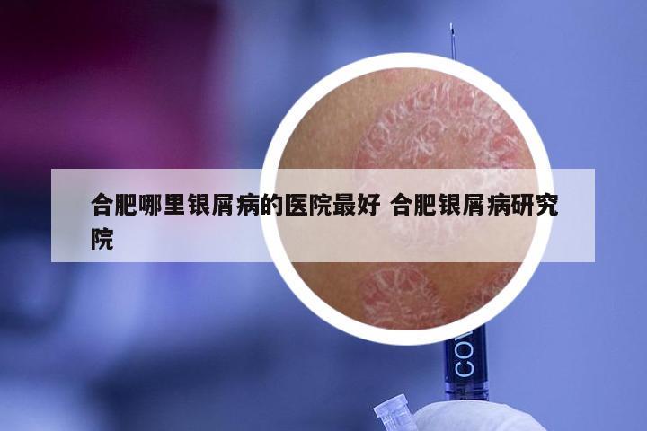 合肥哪里银屑病的医院最好 合肥银屑病研究院