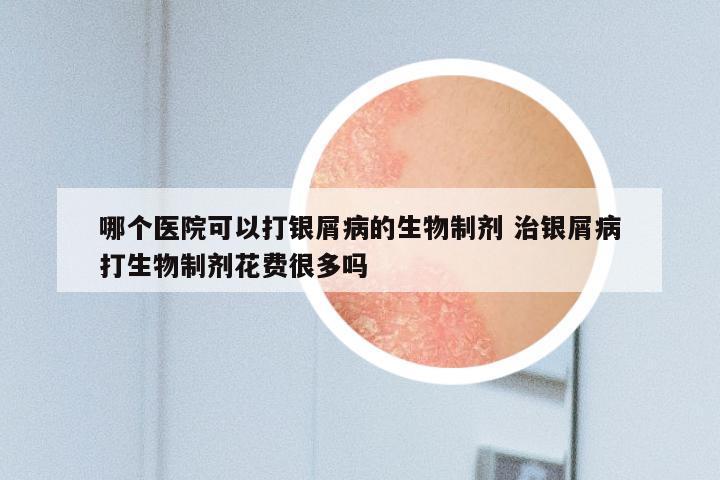 哪个医院可以打银屑病的生物制剂 治银屑病打生物制剂花费很多吗