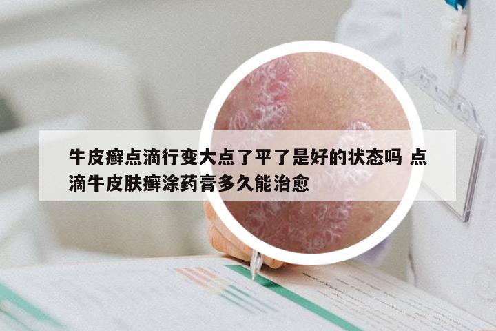 牛皮癣点滴行变大点了平了是好的状态吗 点滴牛皮肤癣涂药膏多久能治愈