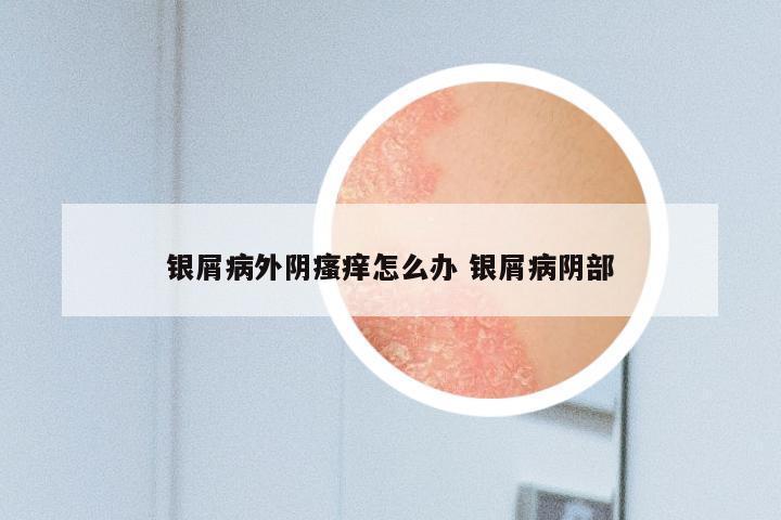 银屑病外阴瘙痒怎么办 银屑病阴部