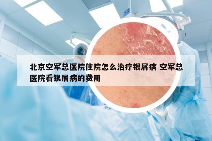 北京空军总医院住院怎么治疗银屑病 空军总医院看银屑病的费用