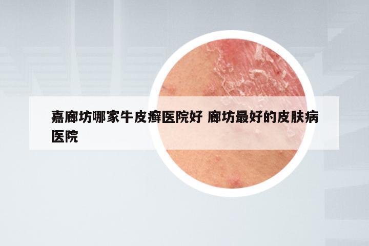 嘉廊坊哪家牛皮癣医院好 廊坊最好的皮肤病医院