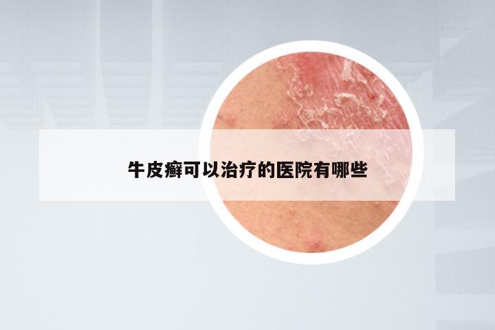 牛皮癣可以治疗的医院有哪些