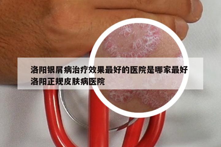 洛阳银屑病治疗效果最好的医院是哪家最好 洛阳正规皮肤病医院