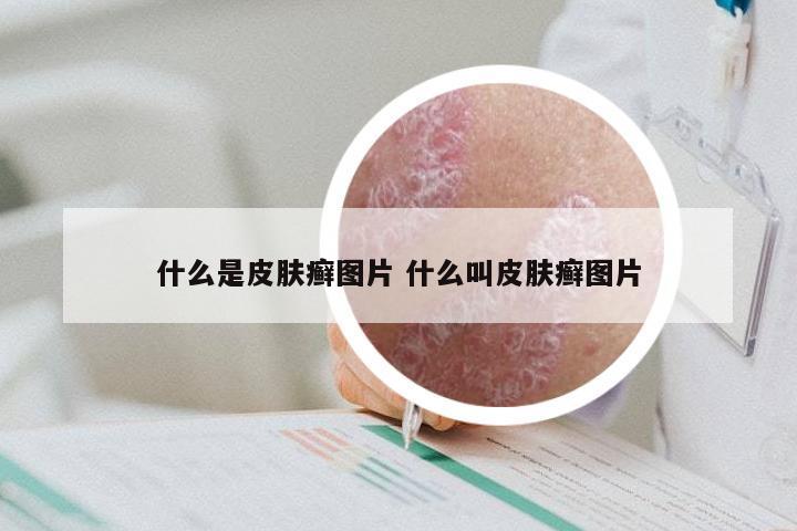 什么是皮肤癣图片 什么叫皮肤癣图片