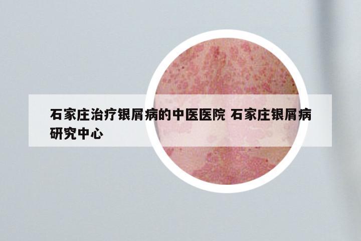 石家庄治疗银屑病的中医医院 石家庄银屑病研究中心